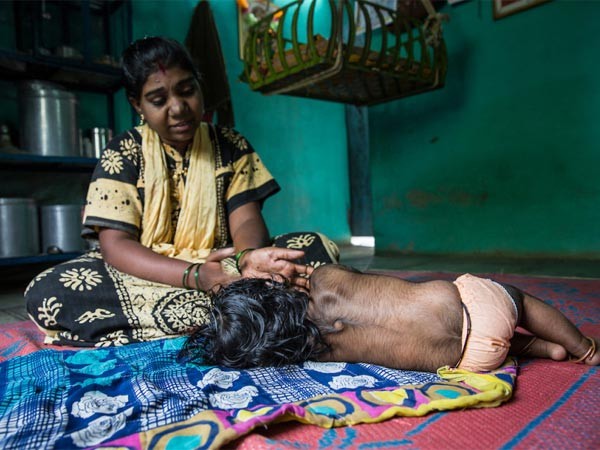 मां की जीन की वजह से बच्चा भालू जैसा पैदा हुआ मां की जीन की वजह से बच्चा भालू जैसा पैदा हुआ